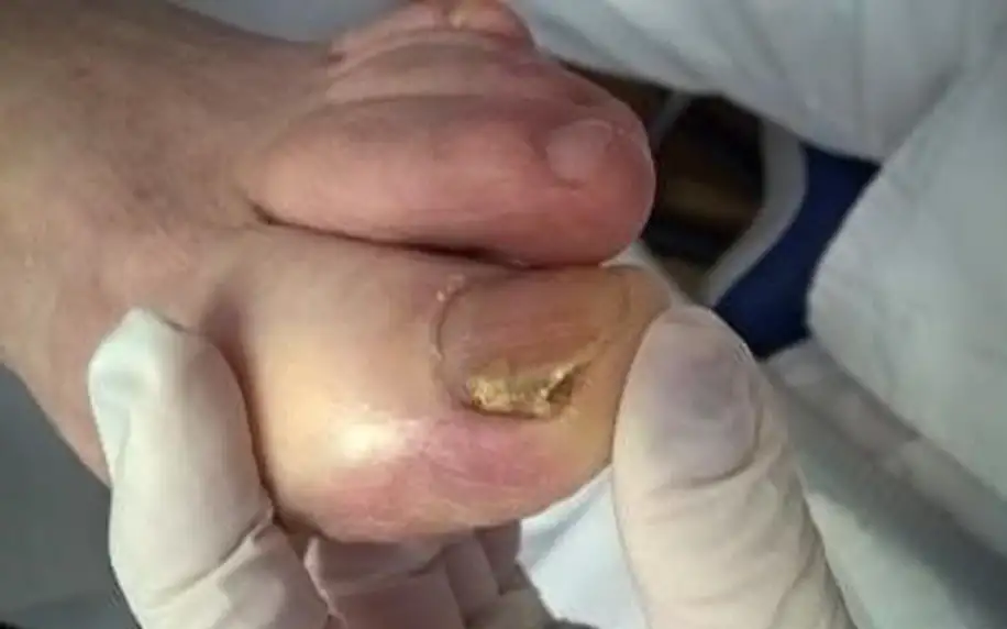 Laserové ošetření mykózy pro zdravé nehty