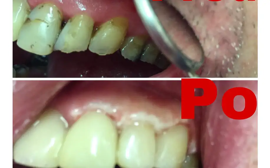 Kvalitní plomba: Obnova povrchu celého zubu