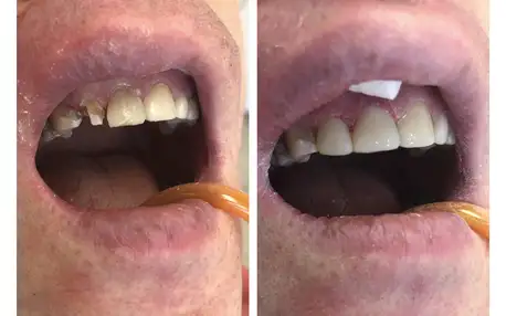 Kvalitní plomba: Obnova povrchu celého zubu
