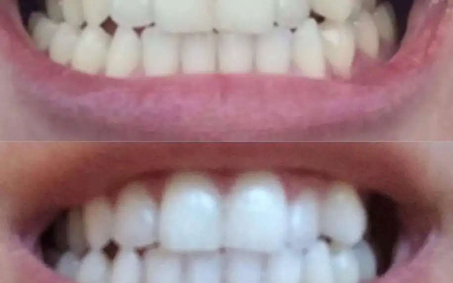 Zářivý úsměv: ordinační bělení zubů