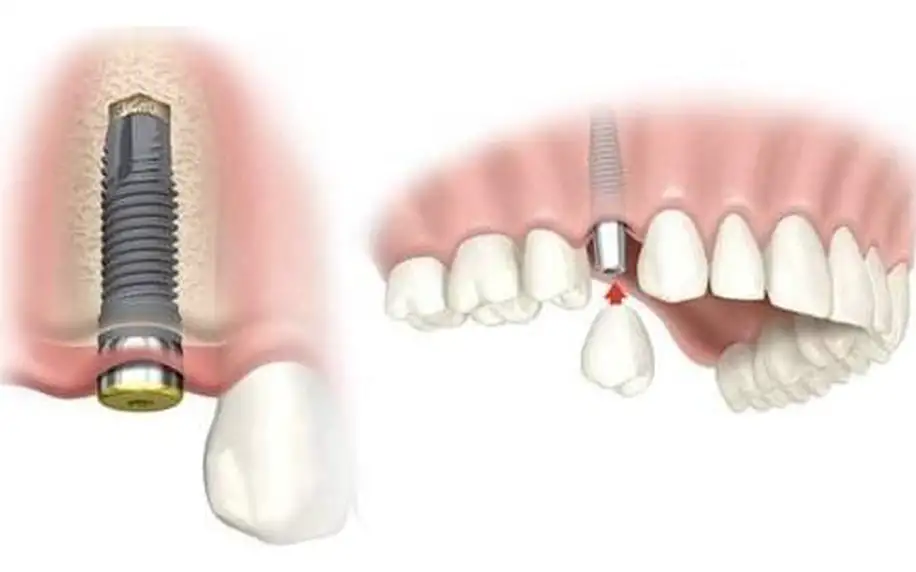 Zavedení zubního implantátu a špičková péče