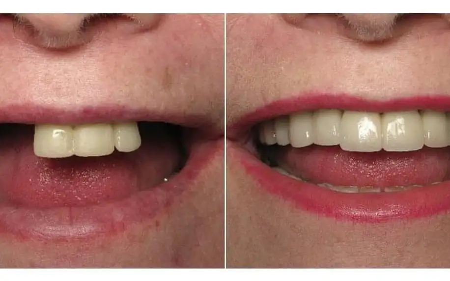 Zavedení zubního implantátu a špičková péče