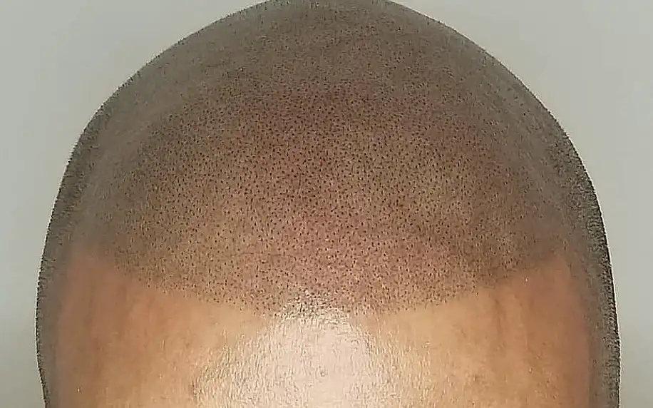 Mikropigmentace vlasů pro muže i ženy