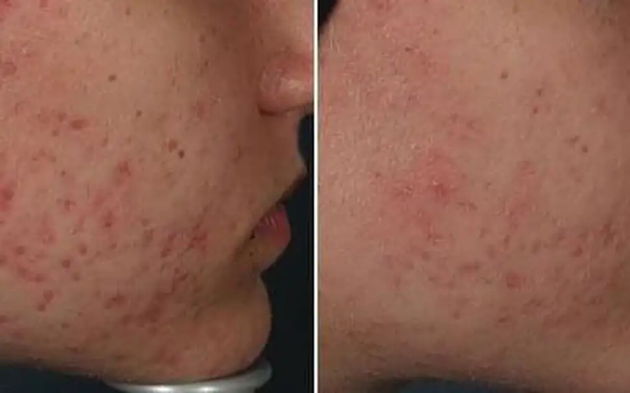 Dvoufázové odstranění akné i vrásek pomocí Face-Up