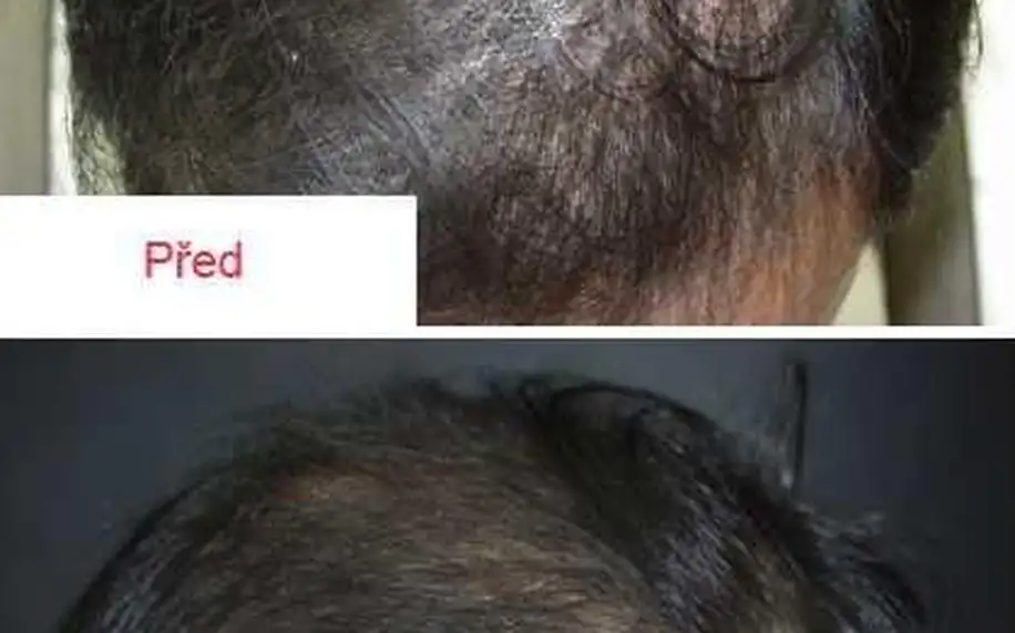 Vlasová mezoterapie: 1 nebo 3 ošetření